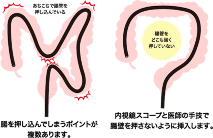 負担の少ない軸保持短縮法