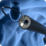 検査中に発見した大腸ポリープは、その場で切除可能です